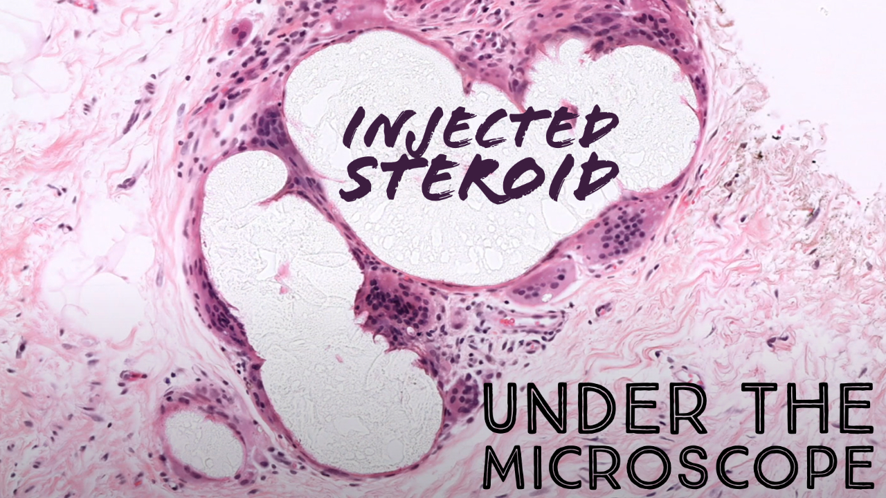 Steroid injection under the microscope (kenalog with giant cell
